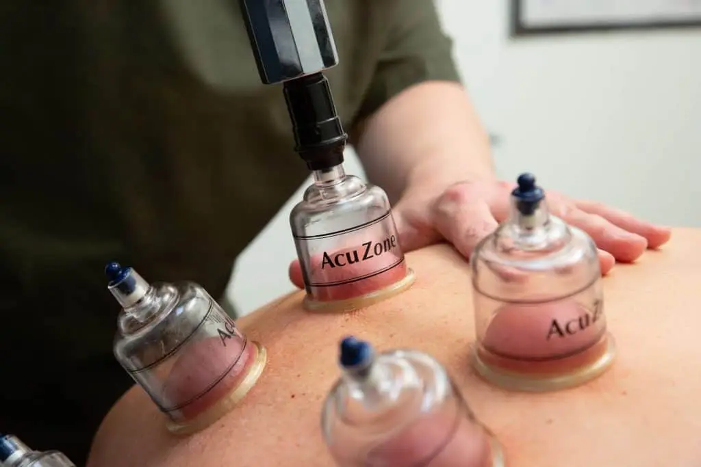 Cupping therapy cups applied during a massage session at Well Being in Akron, Ohio